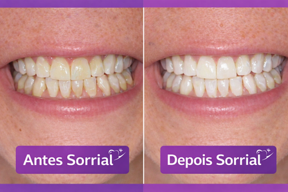 Sorrial Fitas Branqueadoras
